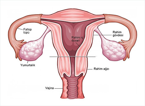 Çikolata Kisti Adetle Atılır mı? - Ankara Jinekoloji Muayenehanesi